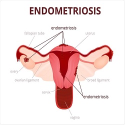 Endometriosis