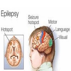 Epilepsy and Seizures