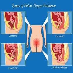 Pelvic Floor Prolapse