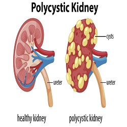 Polycystic kidney disease