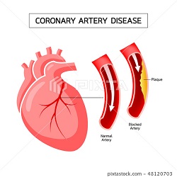 coronary artery disease