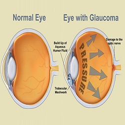 Glaucoma